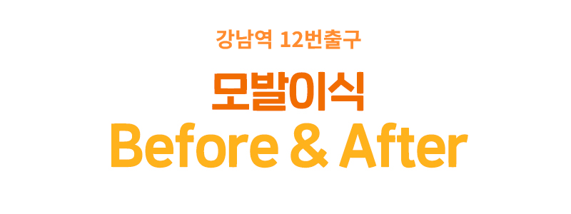 모발이식 before after